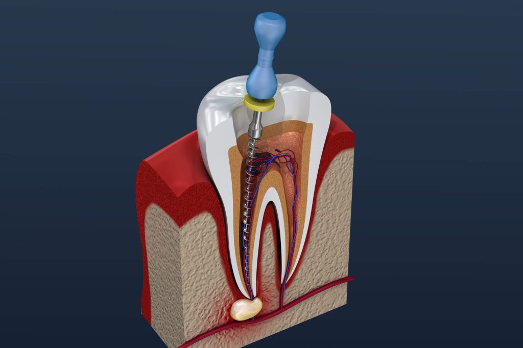 Advances In Root Canal Therapy And Technology