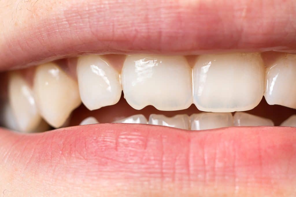 5 Signs You Cracked a Tooth