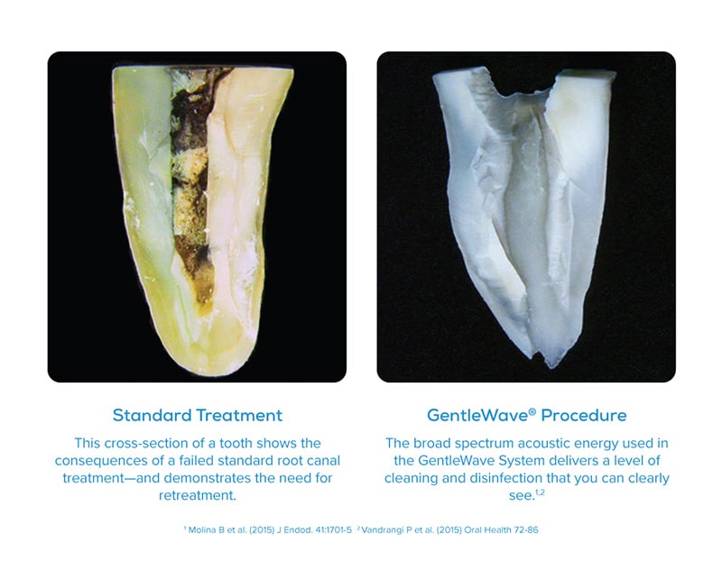 Gentle Wave Procedure Illustration