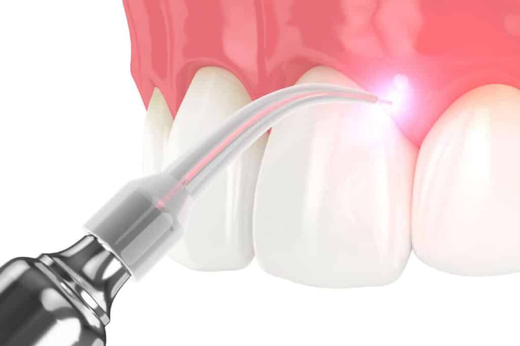How Laser Dentistry Can with Help Treat Oral Mucositis